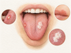 Close view of a tongue and lower lip showing three common mouth sore patterns: a shallow canker sore with pale center and red rim on the tongue side, tiny fluid-filled cold sore blisters near the lip, and a white thrush patch on the tongue.